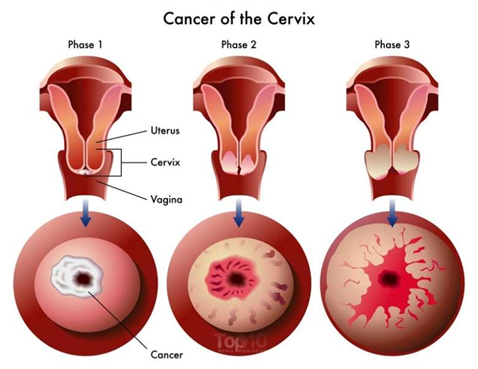 Cancer of the Carvix