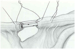 Tubal Ligation Reversal Procedure