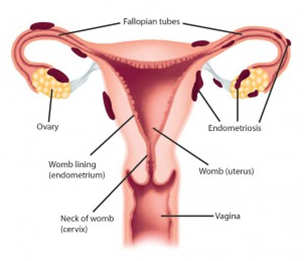 endometriosis blocked fallopian tubes