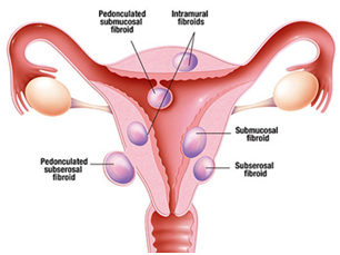 Uterine Fibroid img2